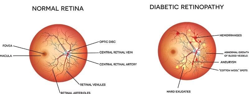 Chart Illustrating a Normal Retina Compared to One With Diabetic Retinopathy