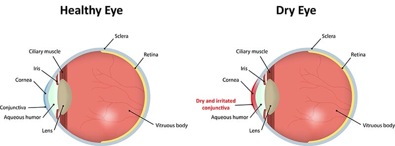 Chart Illustrating a Healthy Eye Compared to One Experiencing Dry Eye