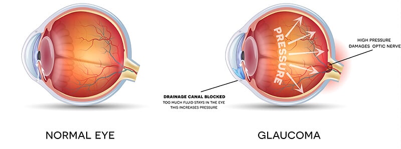 Chart Illustrating a Normal Eye Compared to One With Glaucoma