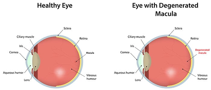 Chart Illustrating a Healthy Eye Compared to One WIth a Degenerated Macula