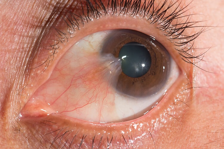 Closeup of Pterygium