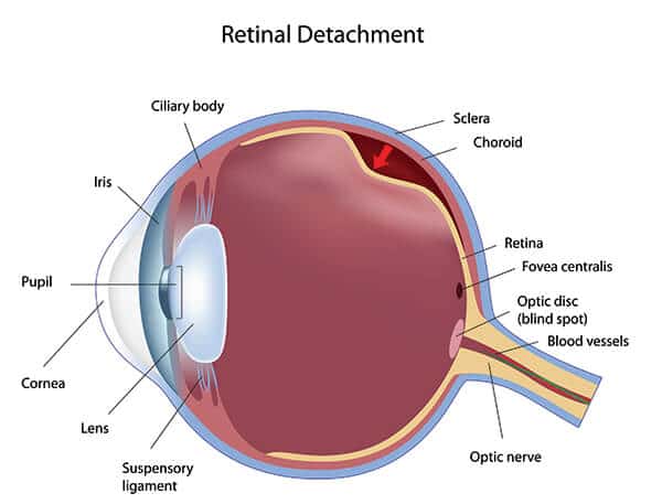 Chart Illustrating What Happens During a Retinal Detachment